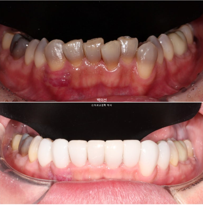 Treatment Review: No-Prep Laminate for Tetracycline-Stained Teeth image 20
