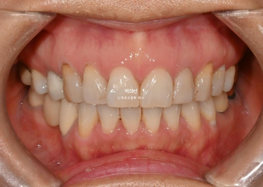 40대 무삭제 라미네이트 블랙트라이앵글 레진 치료 관련 이미지 2