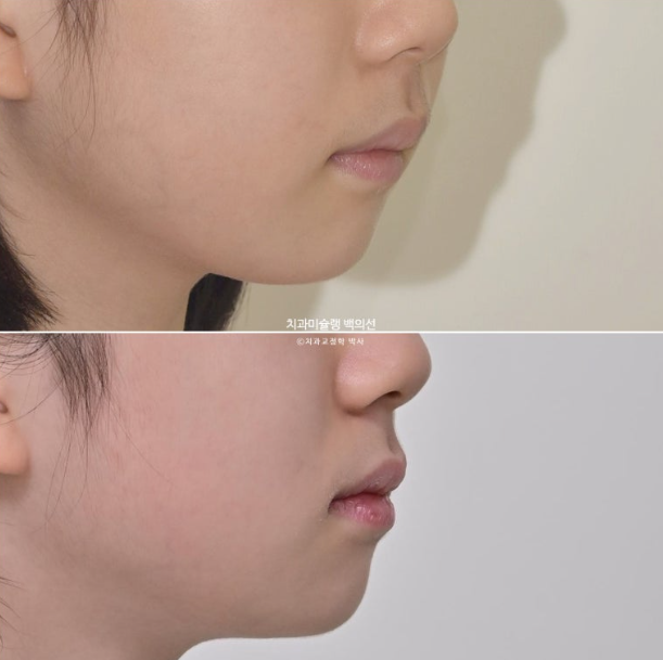 어린이 무턱 성장교정 덧니 인비절라인 퍼스트 악궁확장 치료기간 2년 관련 이미지 35