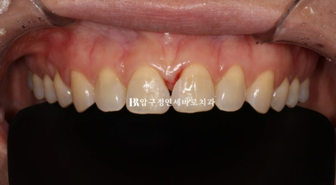 벌어진 치아 교정 인비절라인 라이트 무삭제 라미네이트 치료 관련 이미지 7