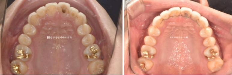 40대 치아교정 인비절라인 라이트 덧니 교정 어금니 교합 부작용 관련 이미지 16