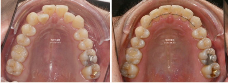30대 MSE 악궁확장 덧니 반대교합 비발치 클리피씨 부작용 관련 이미지 15