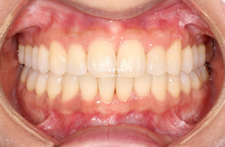 옥니 덧니 과개교합 반대교합 중심선 인비절라인 치료기간 1년 관련 이미지 11