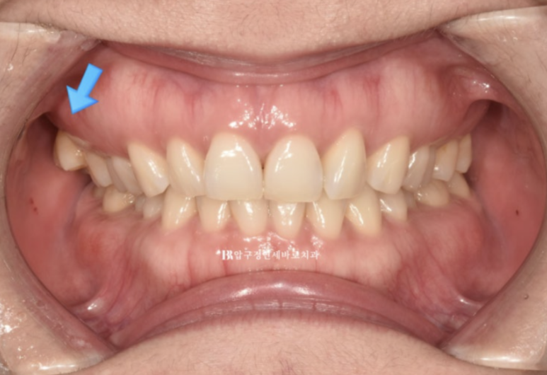 인비절라인 라이트 가위교합 치아 벌어짐 치료 관련 이미지 2