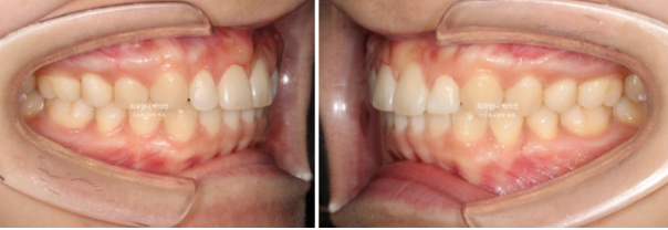 Inward-Tilted Teeth Orthodontic Treatment Review | Actual Case Improved with Non-Extraction Orthodontic Treatment for Gummy Smile, Deep Overbite & Gum Asymmetry — Gangnam Orthodontic Clinic image 11