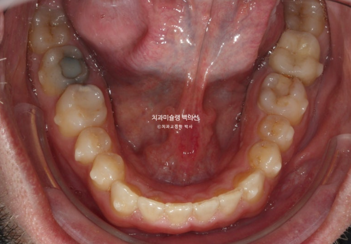 앞니 선천적 결손 인비절라인 임플란트 과개교합 치료 기간 관련 이미지 14