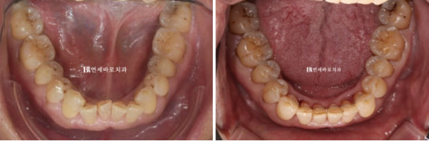 60대 무삭제 라미네이트 앞니 부분교정 치료 관련 이미지 5