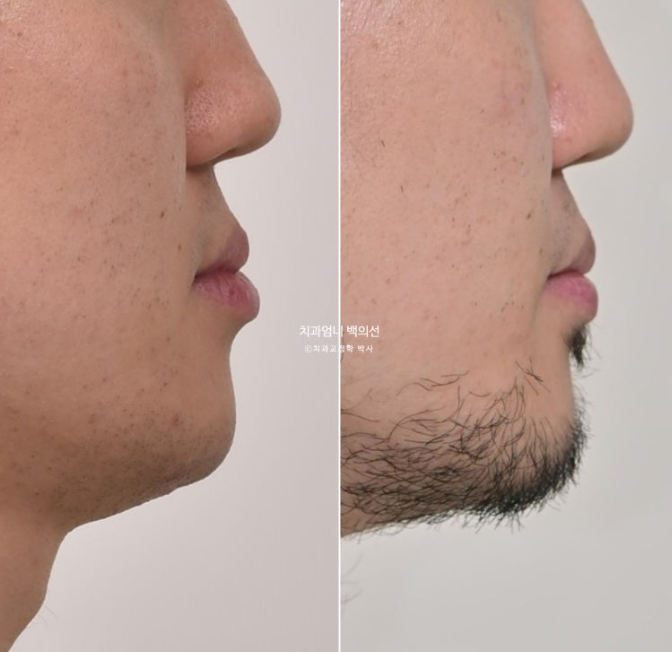 주걱턱 교정 반대교합 소구치 선천적 결손 부정교합 비발치 교정 후기 관련 이미지 1