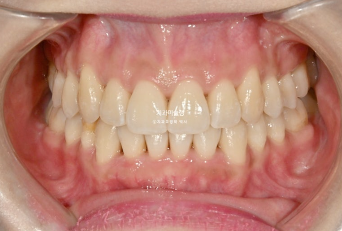 인비절라인 비발치 제2대구치 발치 사랑니 대체 교정 심한 덧니 교정 치료 관련 이미지 17