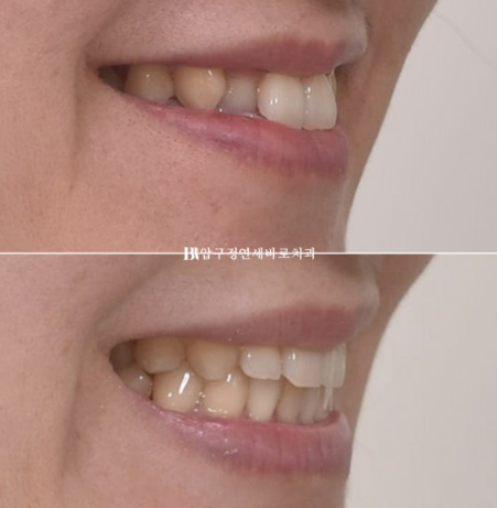 토끼이빨 치아교정 ? 토끼이빨 교정 치료기간은 어떻게 되나요? 관련 이미지 11
