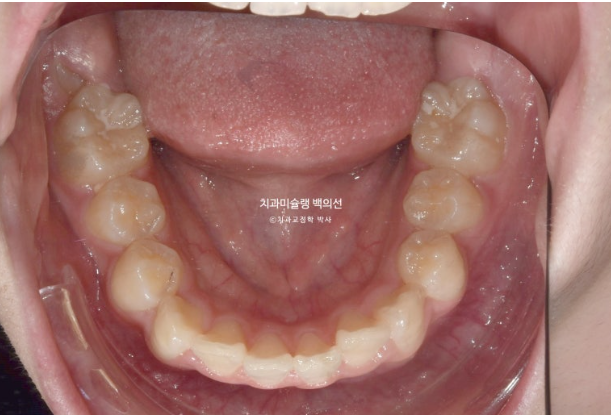 덧니 돌출입 발치교정 상악만 2개 편악 발치 클리피씨 입술부전증 치료 관련 이미지 6