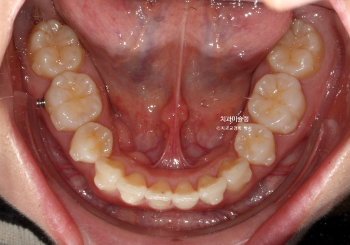 돌출입 덧니 발치 교정 인비절라인 교정 후기 관련 이미지 19