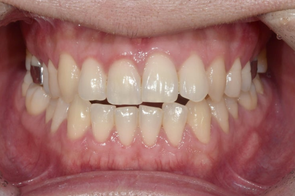 MSE Palatal Expansion Invisalign Underbite Correction, Non-Surgical image 5