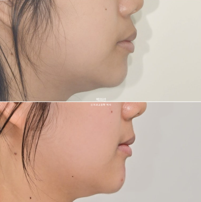 덧니 발치교정 클리피씨 입매 부작용 인중 입술 잇몸 퇴축 관련 이미지 20