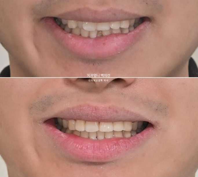 앞니 부분교정 덧니 교정 블랙트라이앵글 부정교합 마모 시뮬레이션 치료기간 5개월 관련 이미지 18