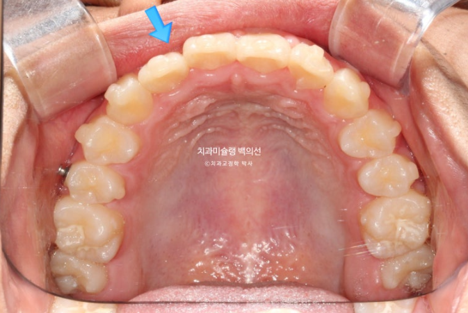 덧니 반대교합 과개교합 인비절라인 퍼스트 악궁확장 어린이 교정 치료 관련 이미지 15