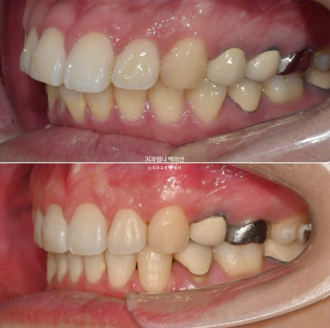 돌출입 발치 교정 인비절라인 후기 미니스크류 관련 이미지 20