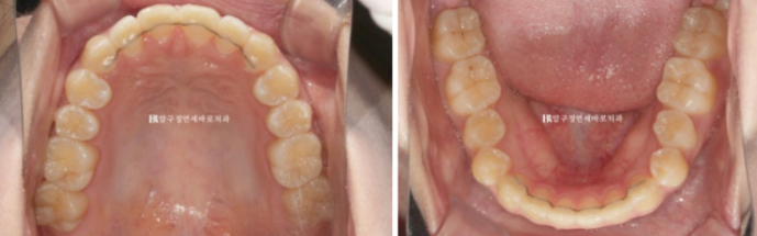 압구정 교정치과 덧니 부분교정 단기교정 후기 관련 이미지 7