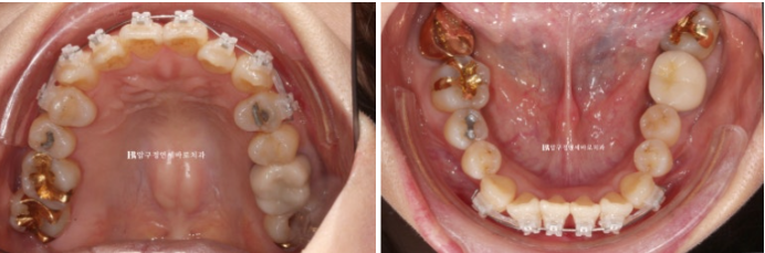 Orthodontics in Your 40s: Worried Your Gums Will Recede? | A 6-Month Front Teeth Partial Orthodontic Case That Also Improved Black Triangles image 4