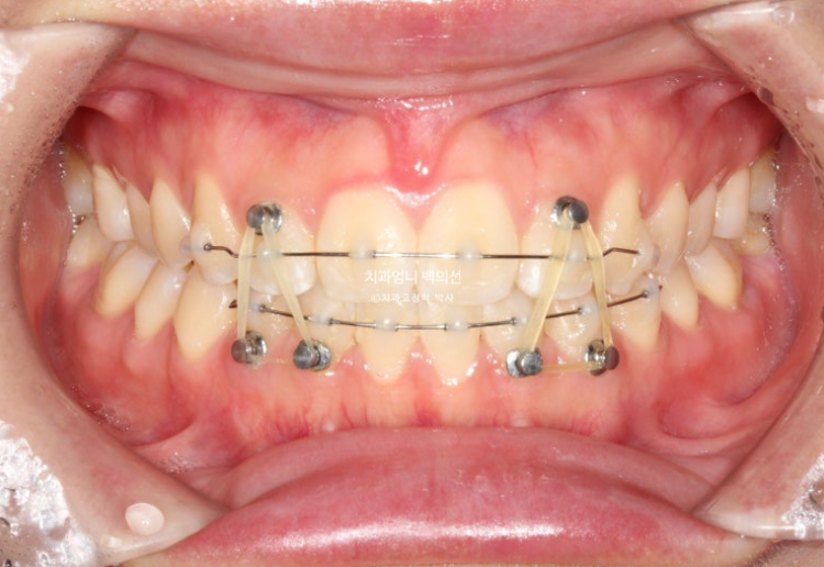 앞니 단기 부분교정 재교정 개방교합 교정 후기 관련 이미지 7
