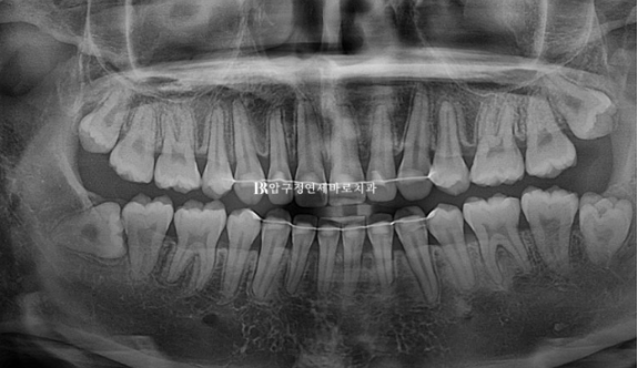 A Review of Extraction Orthodontic Treatment for Protruding Mouth | The Details of Orthodontics That Transform Buccal Corridors and Smile Lines image 17