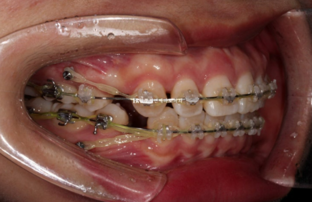 A Review of Extraction Orthodontic Treatment for Protruding Mouth | The Details of Orthodontics That Transform Buccal Corridors and Smile Lines image 5