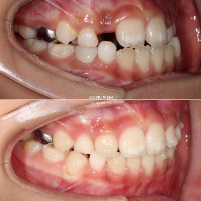 어린이 교정 인비절라인 퍼스트 비대칭 반대교합 어린이 성장 교정 관련 이미지 18