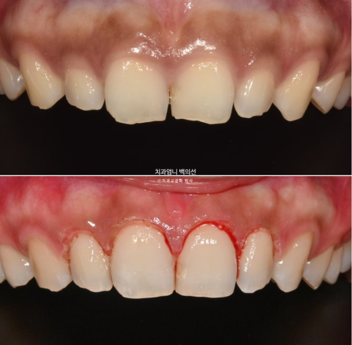 과개교합 옥니 거미스마일 교정 인비절라인 라이트 잇몸성형 후기 관련 이미지 11