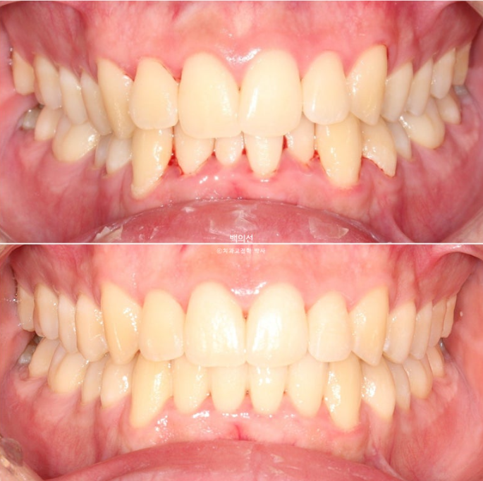 유학생 교정 인비절라인 라이트 치료기간 5개월 관련 이미지 13