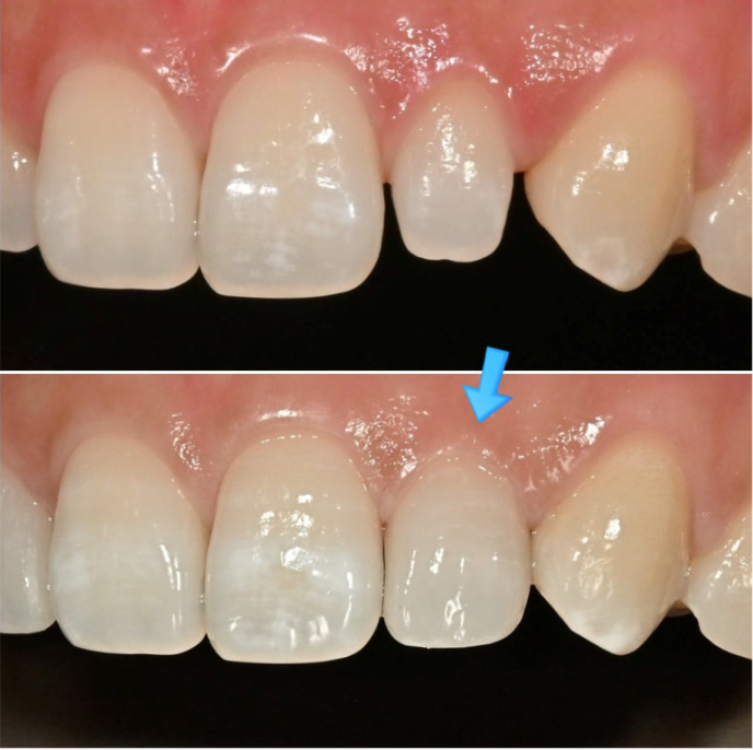 왜소치 반점치 (반상치)가 있는 경우 무삭제 라미네이트 치료 관련 이미지 7