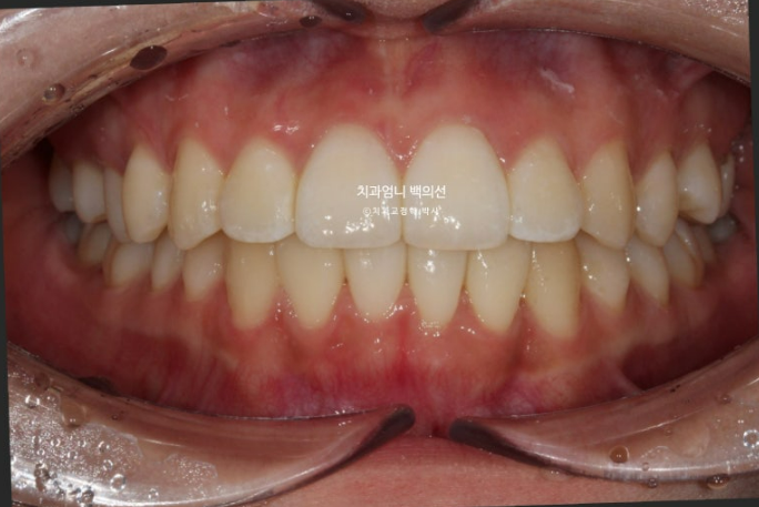 앞니 부분 교정 토끼이빨 덧니교정 ? 관련 이미지 10