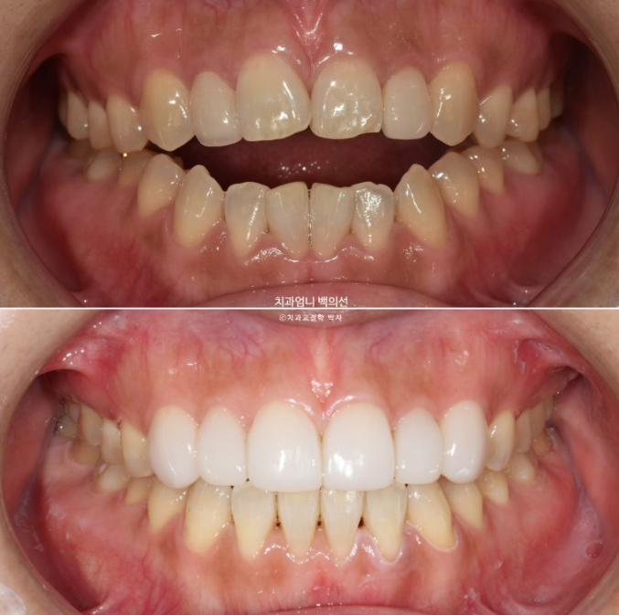 비수술 개방교합 클리피씨 30대 무삭제 라미네이트 치료기간 2년 관련 이미지 1