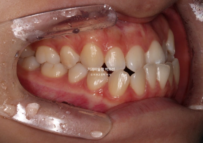 비수술 주걱턱 비대칭 발치 교정 결손치 반대교합 클리피씨 치료기간 1년 11개월 관련 이미지 3
