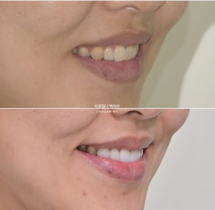 비수술 개방교합 클리피씨 30대 무삭제 라미네이트 치료기간 2년 관련 이미지 20