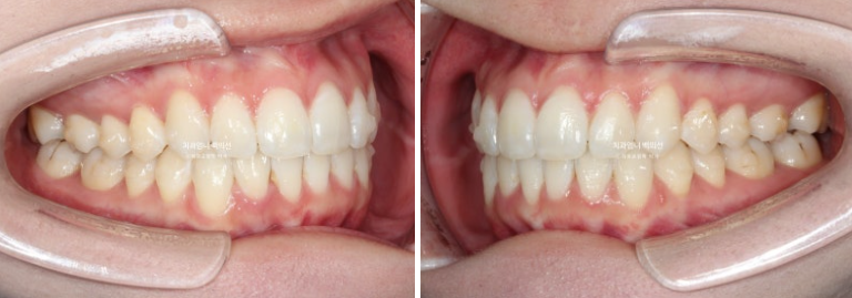 인비절라인 라이트 교정 앞니돌출 과개교합 덧니 교정 관련 이미지 6