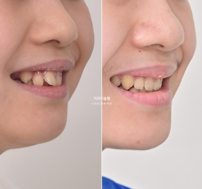 선천적 결손 잔존유치 과개교합 돌출입 인비절라인 퍼스트 어린이 투명교정 치료기간 관련 이미지 24