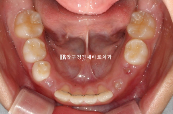 Invisalign First Correction for a Retruded Chin in a Child Orthodontic Treatment for Protrusion image 19