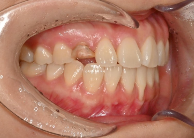 매복 결손 잔존유치 라미네이트 크라운 캔팅 인비절라인 라이트 치료 관련 이미지 4