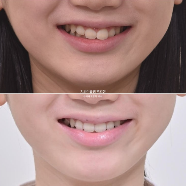 과개교합 인비절라인 모더레이트 컴프레헨시브 중심선 토끼이빨 관련 이미지 17