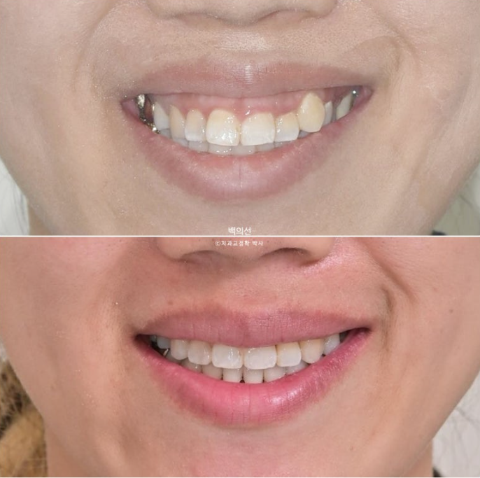 거미스마일 교정 돌출입 발치교정 입술부전 호두턱 치료기간 2년반 관련 이미지 22