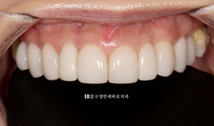 40대 오래된 크라운 교체 / 블랙트라이앵글 젤라미 치료 결과 관련 이미지 4