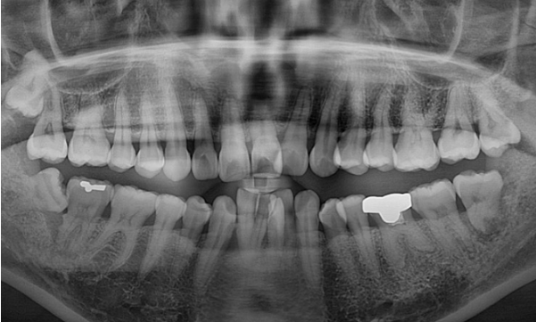 40대 치아교정 가능할까요? 치주염 있어도 치아교정 가능할까요? 임플란트 없이 교정하기 관련 이미지 16