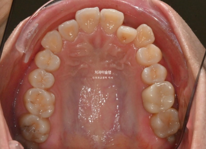 인비절라인 라이트 반대교합? 덧니 중심선 치간삭제 치료 관련 이미지 5