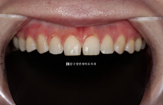 왜소치·원추형 치아, 교정보다 무삭제 라미네이트가 좋은 이유 | 앞니 벌어짐 치료 후기 관련 이미지 4