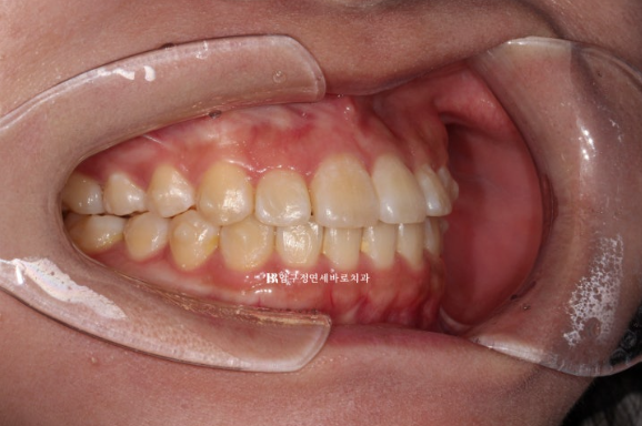서울 인비절라인 치과 재교정 뻐드렁니 교정 관련 이미지 4