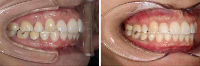 40대 재교정 가능할까요? 비발치 돌출입 교정 호두턱 팔자주름 후기 관련 이미지 6