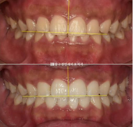 압구정 인비절라인 라이트 과개교합 후기 관련 이미지 11