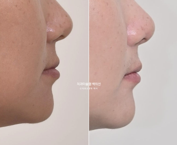 해외거주 앞니 선천적 결손 과개교합 인비절라인 라이트 브릿지 치료 관련 이미지 21