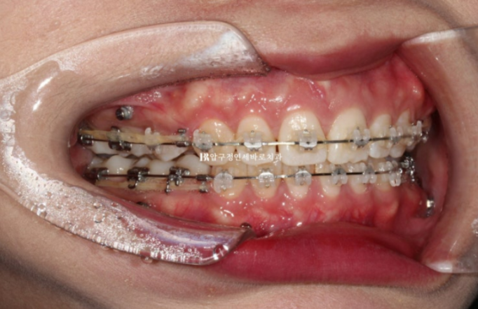 How Do the Buccal Corridors and Smile Line Change After Extraction Treatment for Protruding Teeth?|An Orthodontic Case That Also Improved Lip Incompetence image 8
