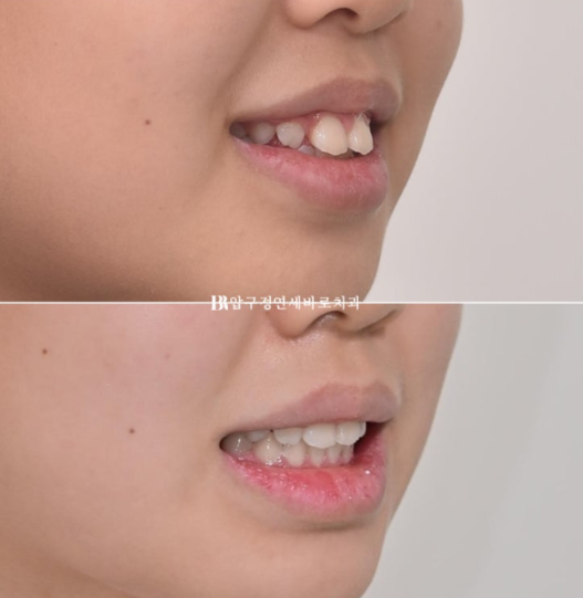 강남 소아교정 인비절라인 퍼스트 어린이 반대교합 관련 이미지 16